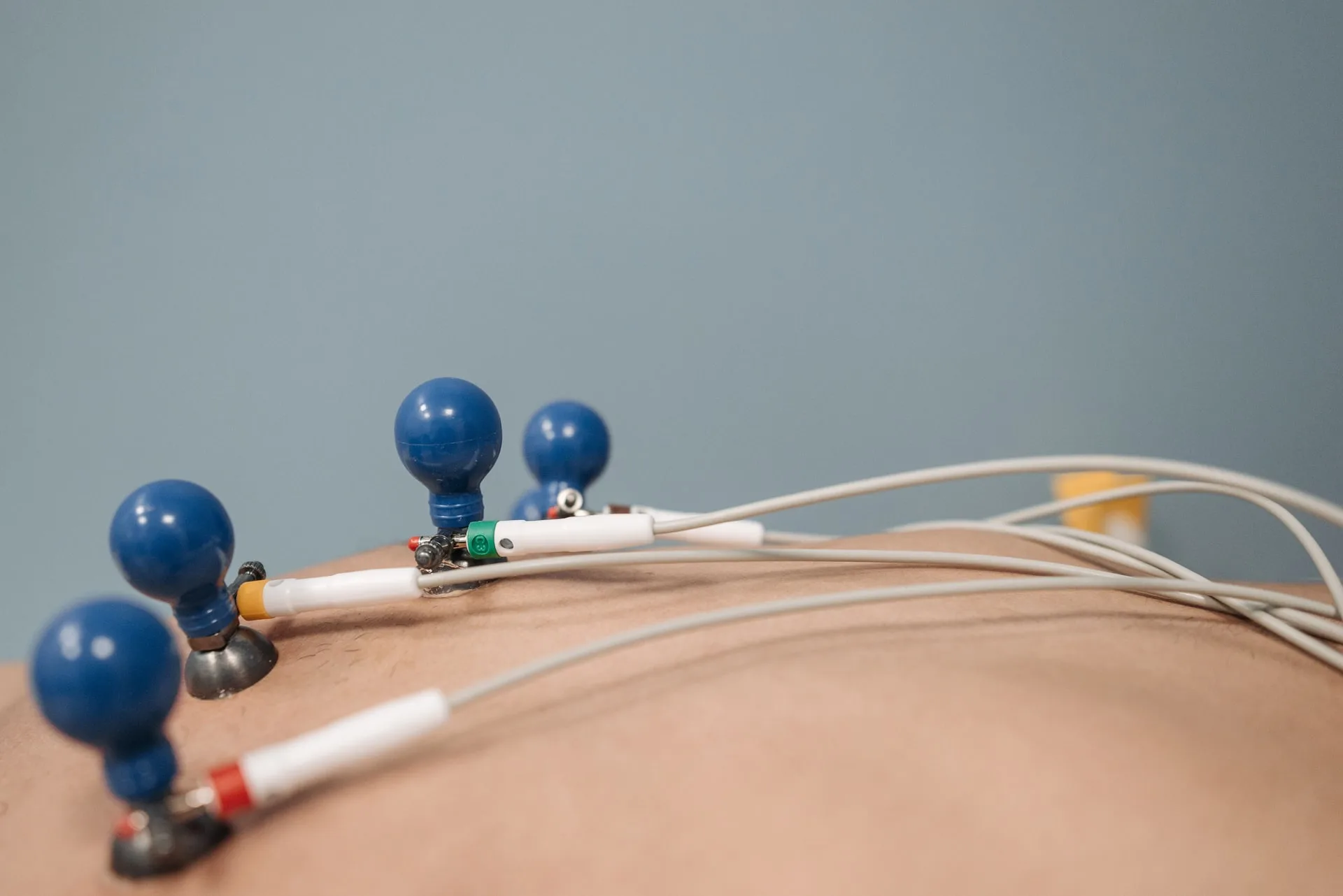 Électrodes de recueil posées sur le dos d’un patient, reliées par câbles
